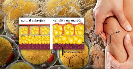 A cell-lite és a narancsbőr